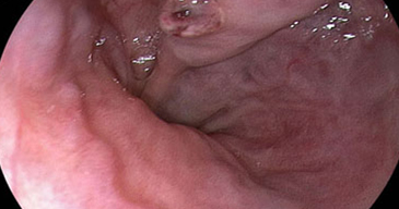 Endoscopia